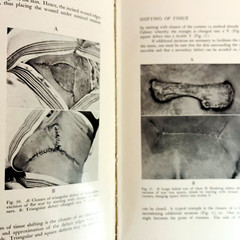 Vintage Plastic and Reconstructive Surgery 3rd Edition Book Hardcover 1971 Hans